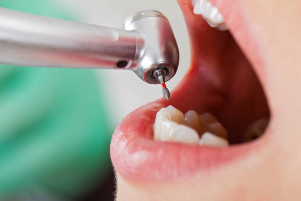 Best Emergency Root Canal Treatment in Metropolis, IL